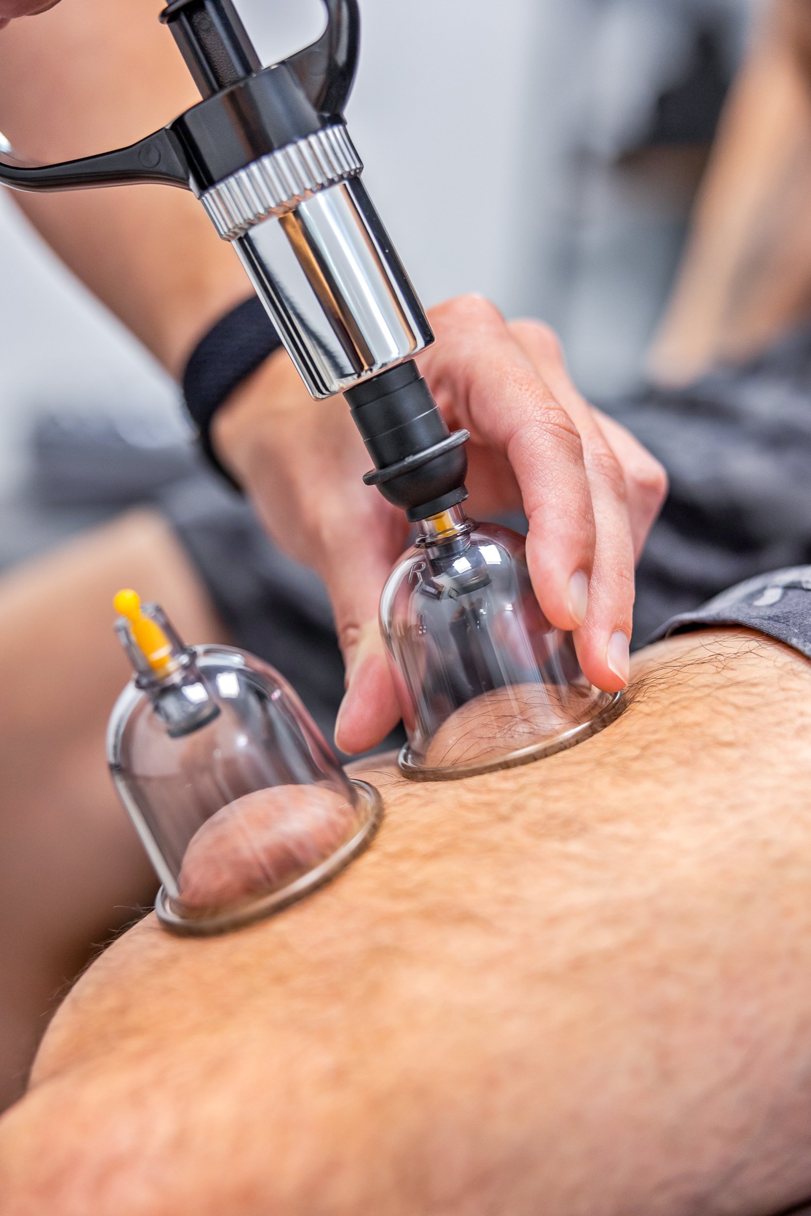 cupping physical therapy