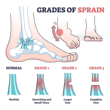 The Different Types of Ankle Sprain | Ankle, Ankle Sprains and more | Niel  Asher Education Blogs and Articles blog