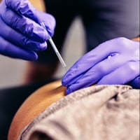 dry needling, cupping, dry needling physical therapy